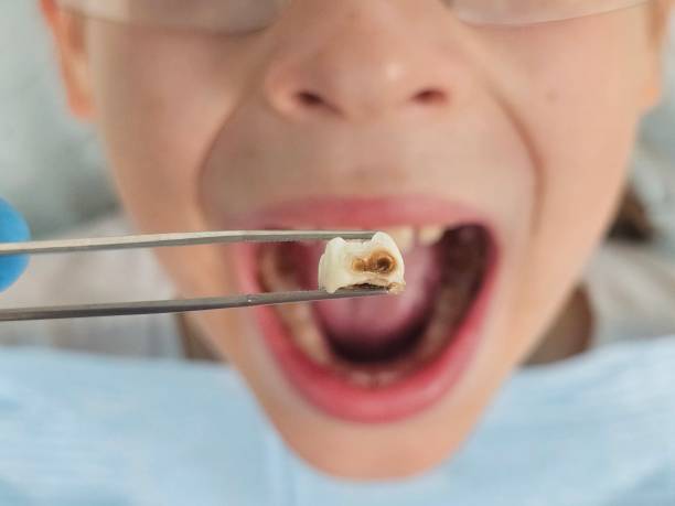 Best Emergency Dental Extractions in New Brighton, PA