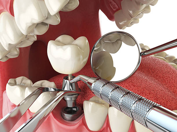Best Emergency Dentist for Lost Fillings or Crowns in New Brighton, PA